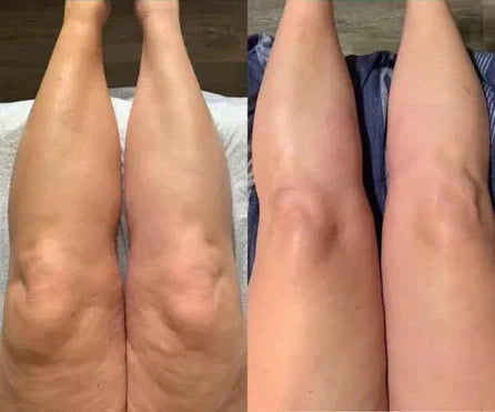 Water retention or lymphatic drainage: how to tell the difference? Image